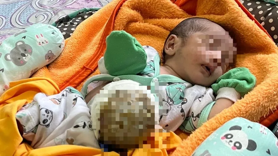 Bayi 2 Bulan Asal Pandeglang Lahir dengan Usus di Luar Perut, Butuh Uluran Tangan